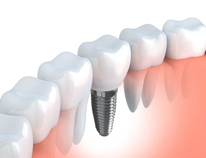整个种植牙修复过程要多久-四川义齿厂家