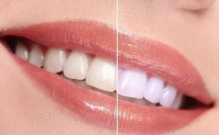 牙齿太黄要变白的问题-成都种植牙厂家
