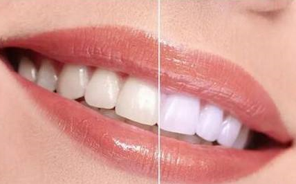 牙齿太黄要变白的问题-成都种植牙厂家