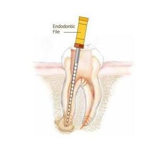 什么叫根管治疗-四川义齿厂家