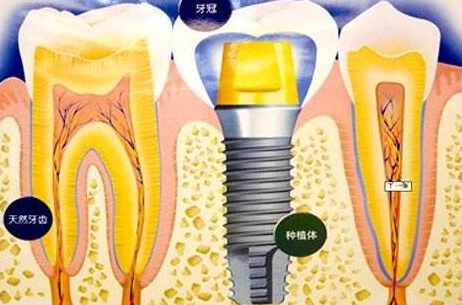 种植牙齿有什么坏处-义齿厂家