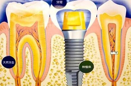 种植牙齿有什么坏处-义齿厂家