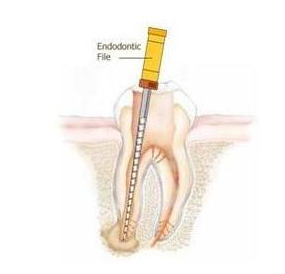 什么叫根管治疗-四川义齿厂家