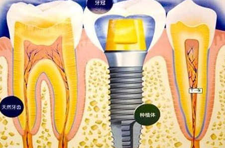种植牙齿有什么坏处-义齿厂家