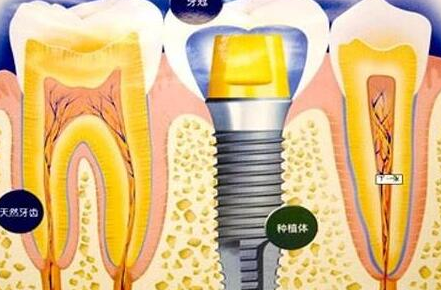 种植牙齿有什么坏处-义齿厂家