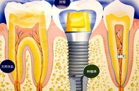 种植牙齿有什么坏处-义齿厂家
