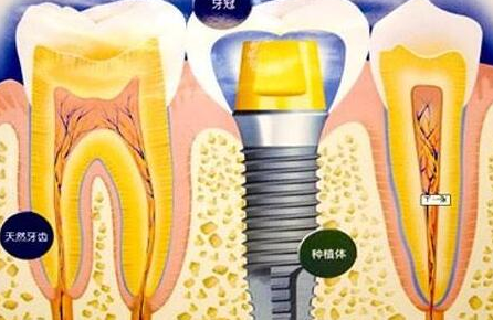 种植牙齿有什么坏处-义齿厂家
