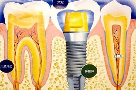 种植牙齿有什么坏处-义齿厂家