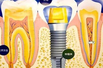种植牙齿有什么坏处-义齿厂家