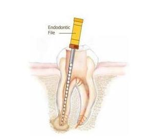 什么叫根管治疗-四川义齿厂家