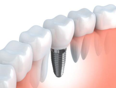 整个种植牙修复过程要多久-四川义齿厂家