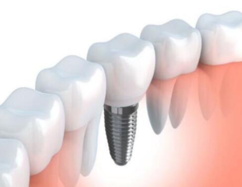 整个种植牙修复过程要多久-四川义齿厂家