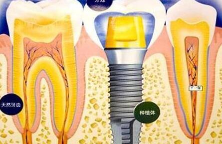 种植牙齿有什么坏处-义齿厂家