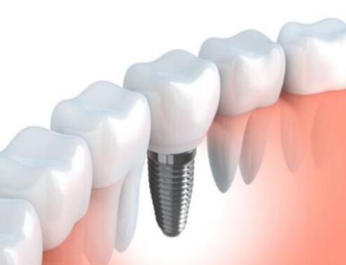 整个种植牙修复过程要多久-四川义齿厂家