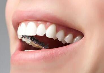 做种植牙修复脱落牙齿的优点有哪些-成都种植牙厂家