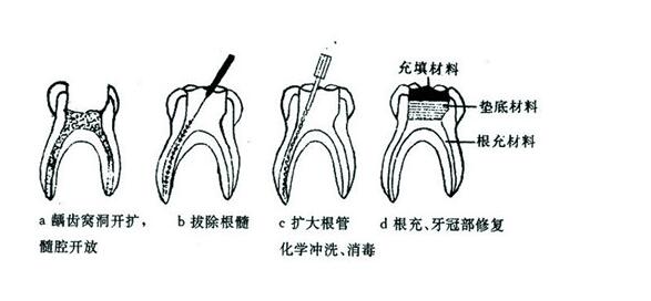成都义齿厂家